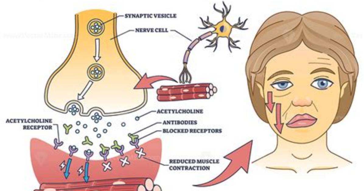 What Neurotransmitter Is at Fault with Myasthenia Gravis?