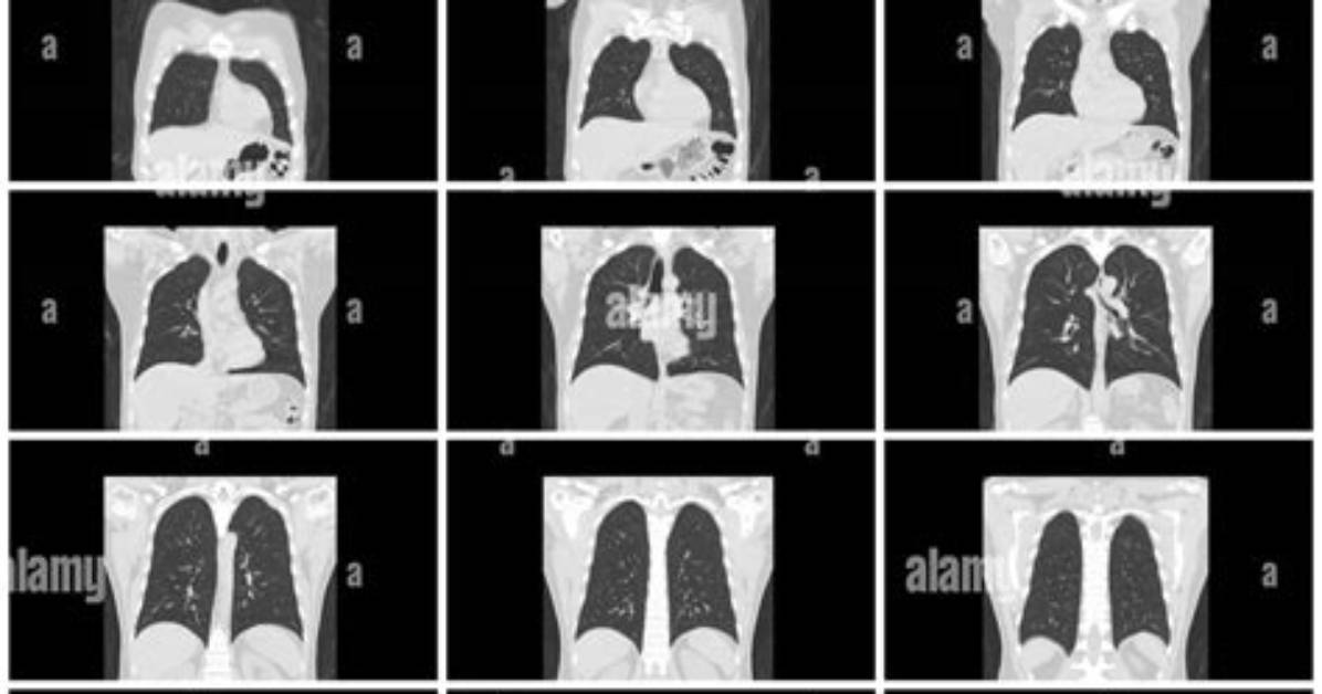 What Organs Does a Chest Ct Scan Show?
