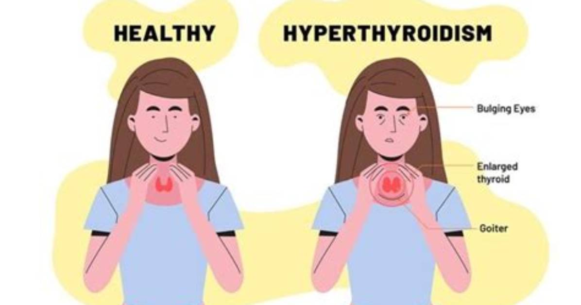 What Overactive Thyroid Means?