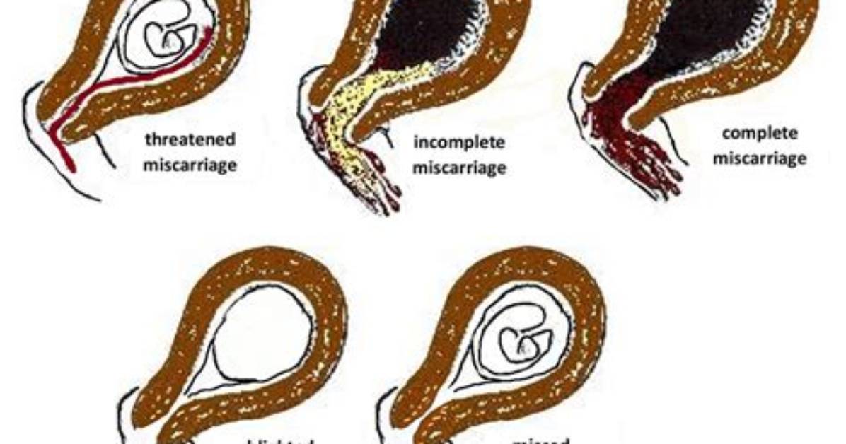 What Represents a Miscarriage?