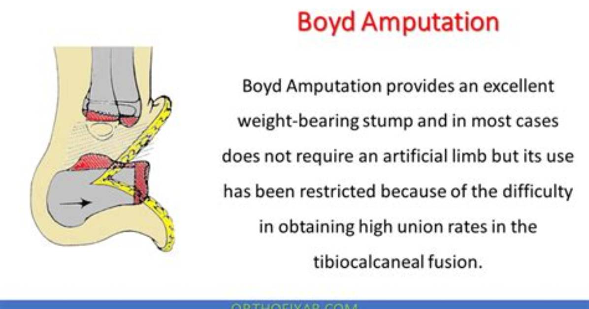 What's a Boyd Amputation?