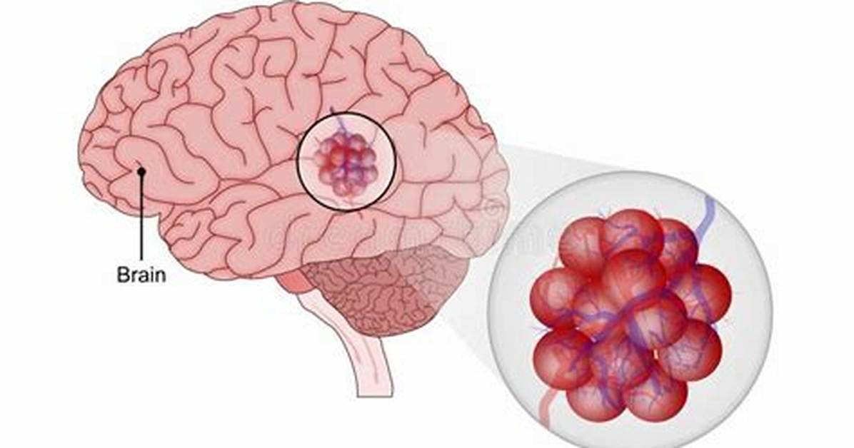 What's a Cavernous Malformation?