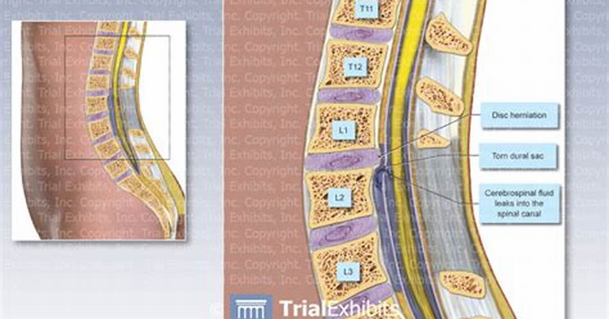 What's a Dural Tear?