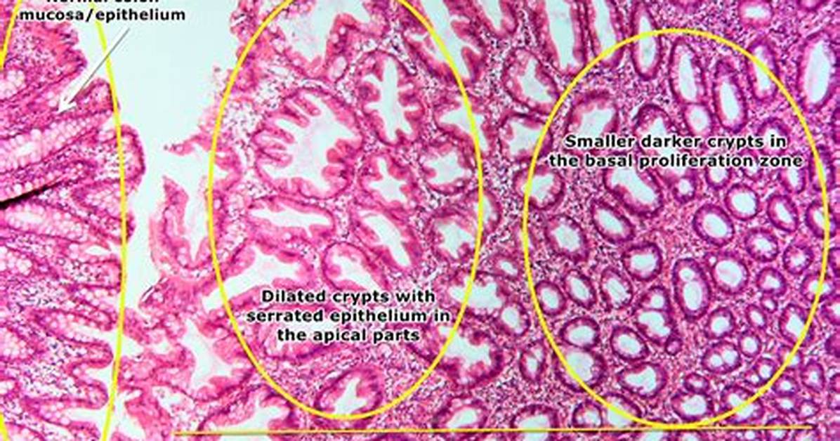 What's a Hyperplastic Polyp?