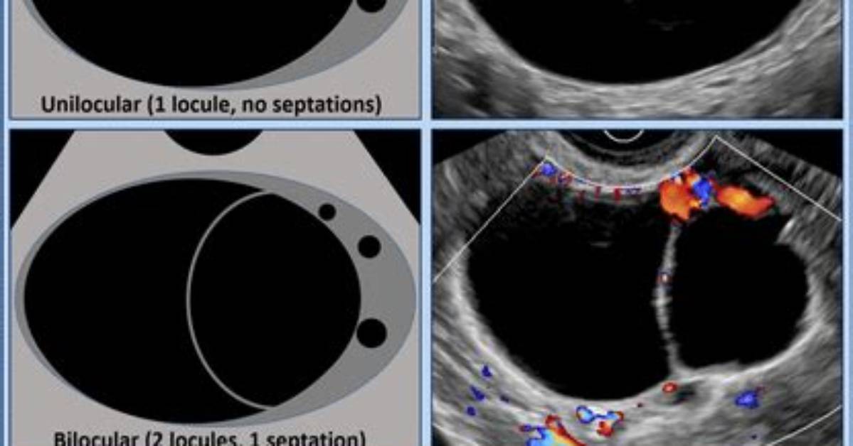 What's a Multilocular Cyst?