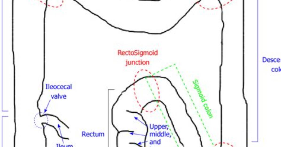 What's a Rectosigmoid Junction?