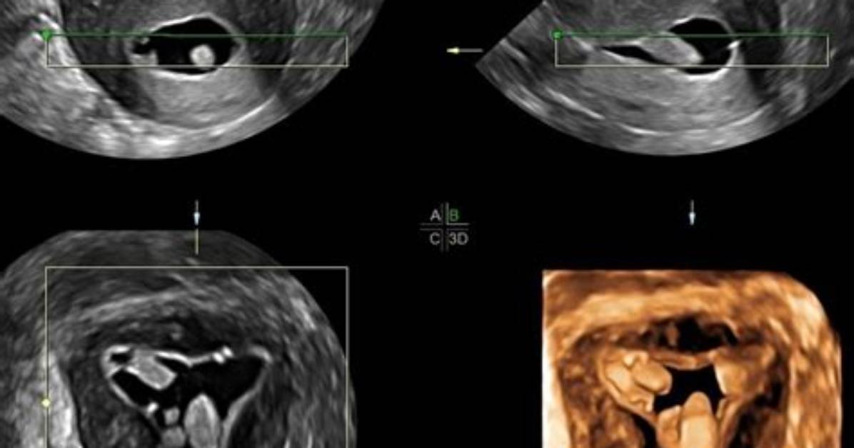What's a Saline Sonogram?