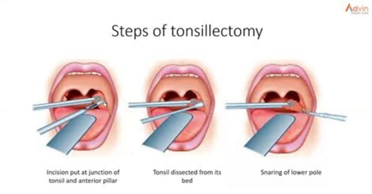 What's a Tonsillectomy Surgery?