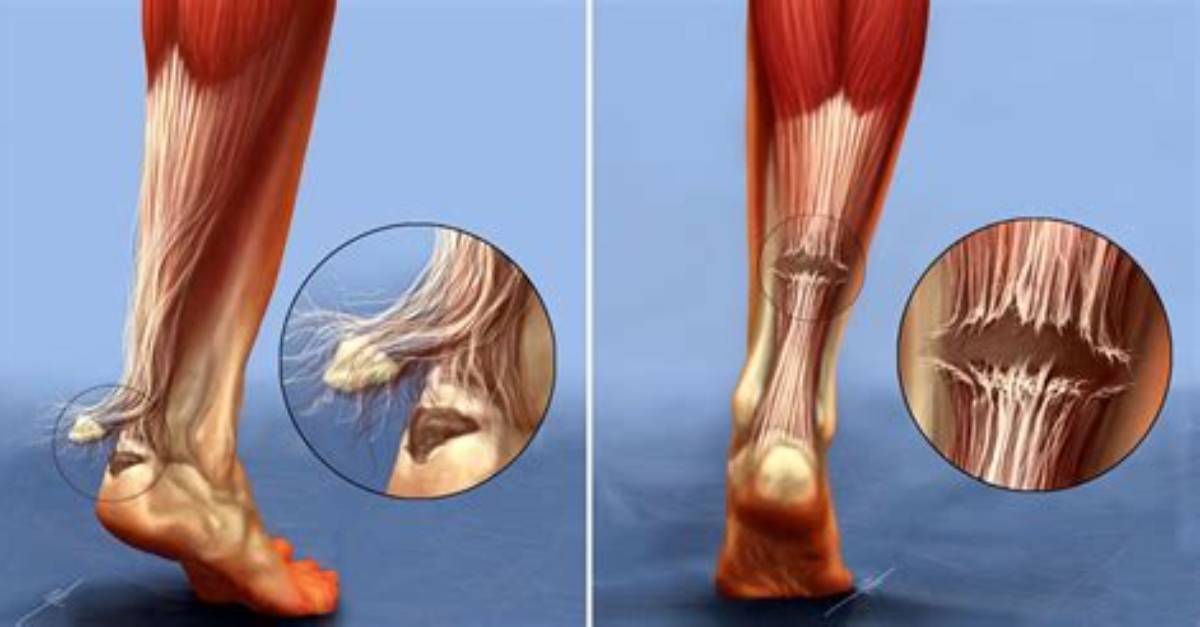 What's a Torn Tendon?