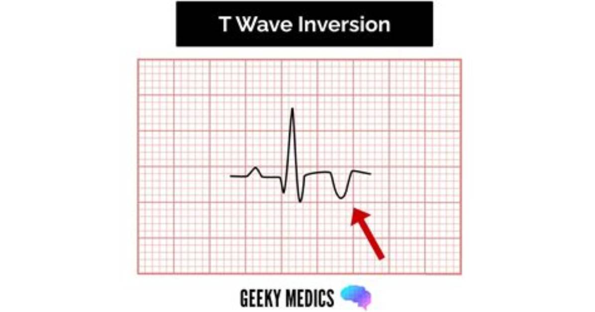 What's an Inverted T Wave?
