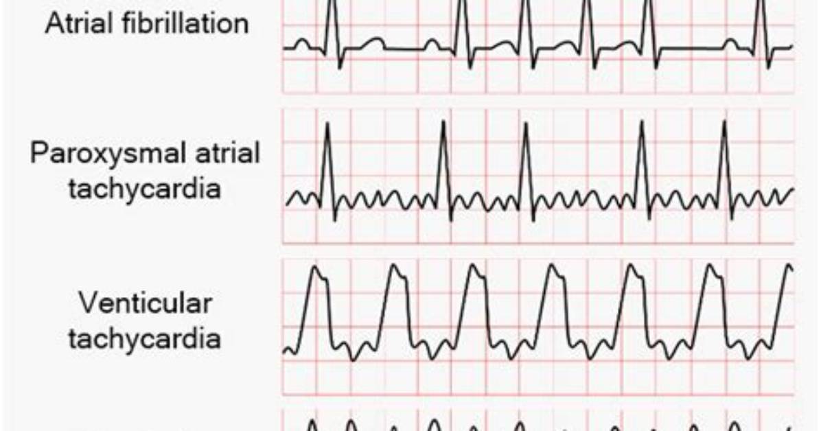 What's Diff Between Arrhythmia and Dysrhythmia?