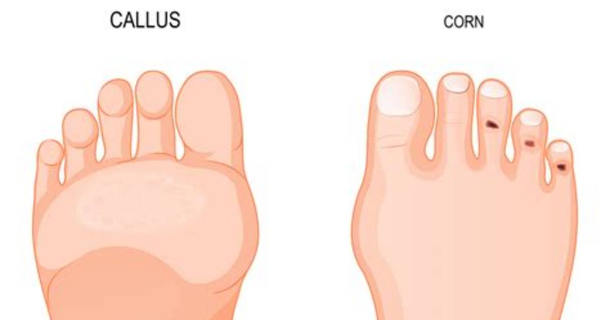 What's the Difference Between a Callus and a Blister?