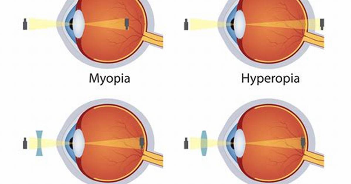 What’s the Difference Between Myopia and Hyperopia?