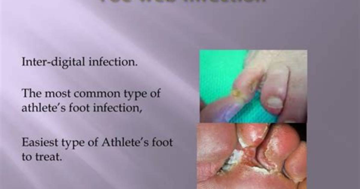 What's Toe Web Infection?