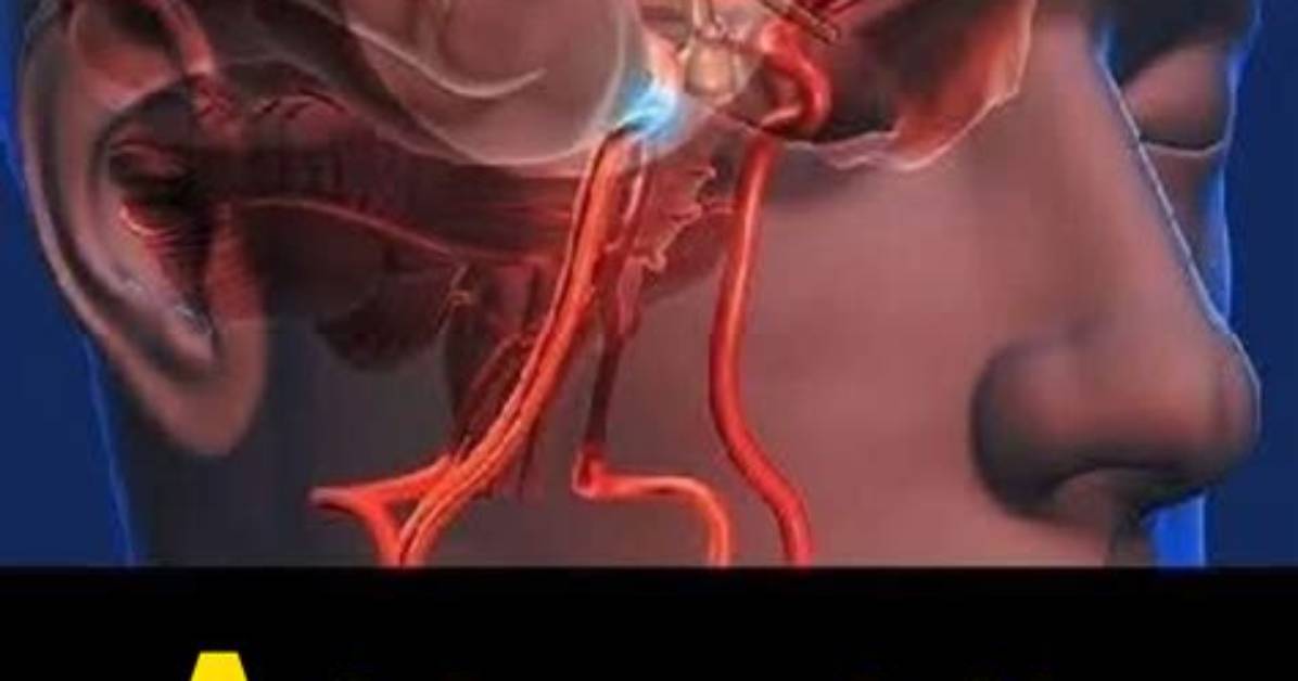 What's Wrong with Aneurysms?