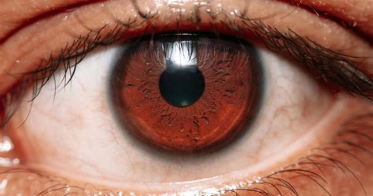 What's Wrong with Urias Eye?