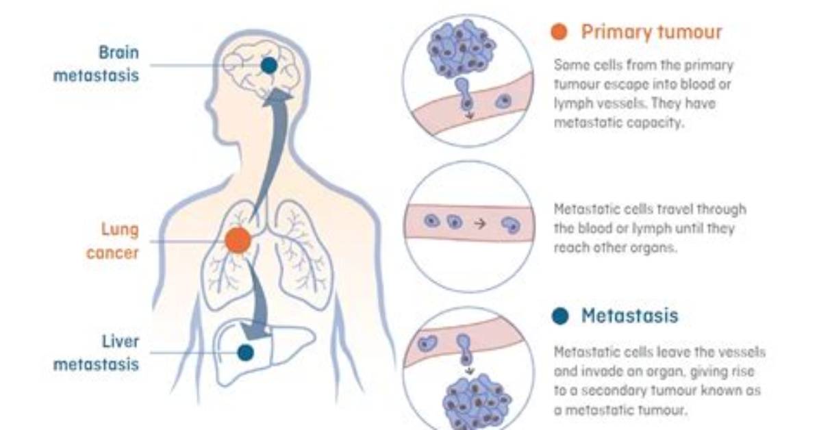 What Stage Does Metastasis