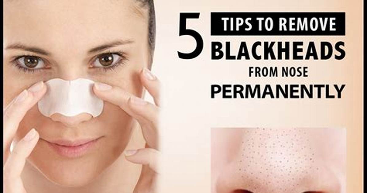 What Will Remove Blackheads?