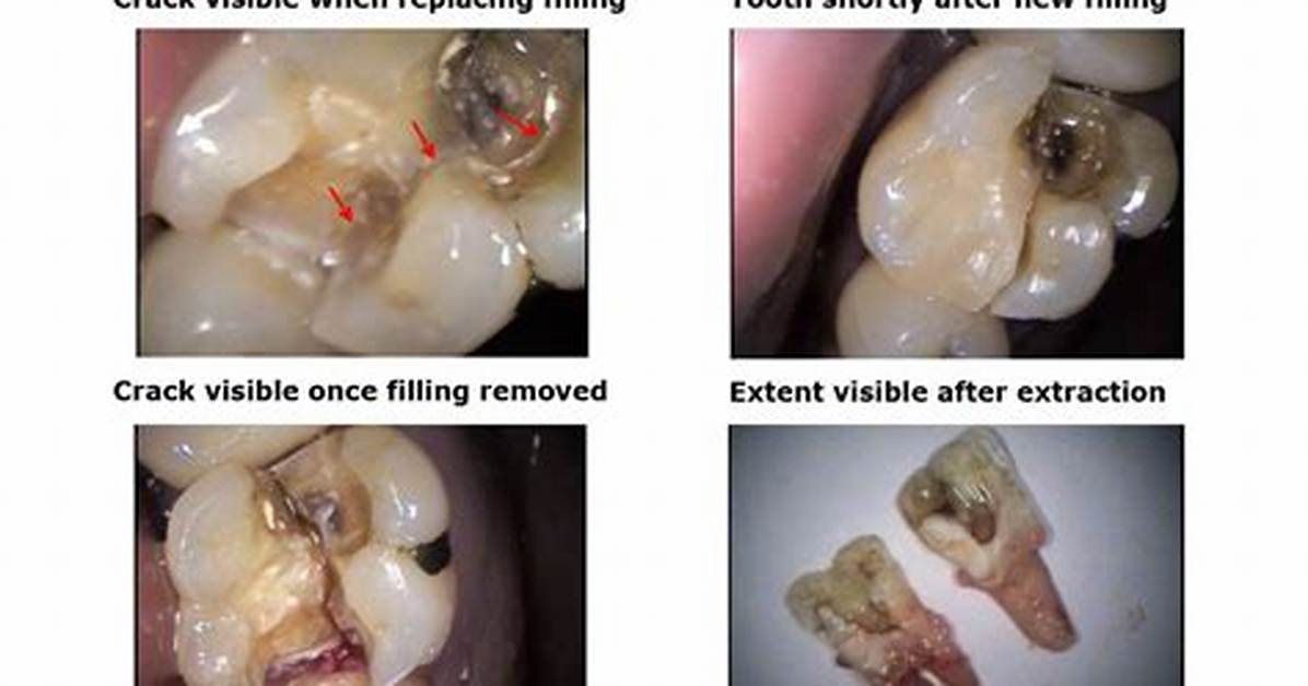 When a Tooth Cracked in Half?