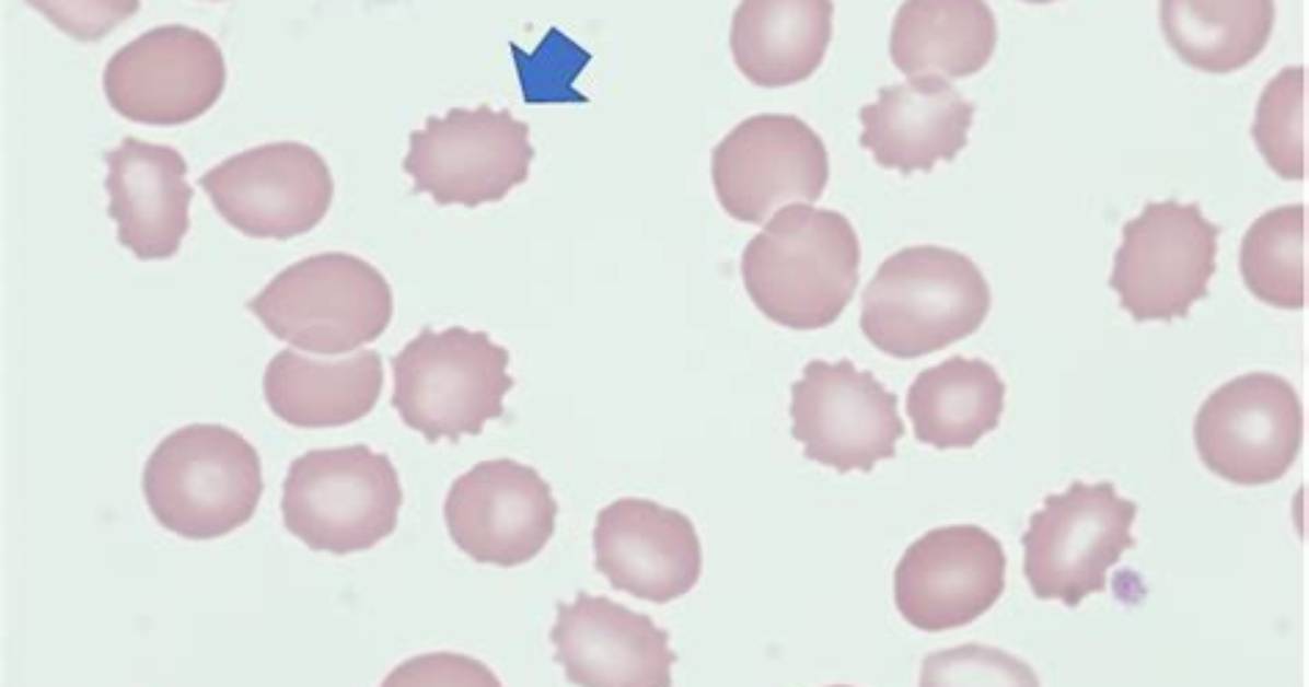 When Are Burr Cells Seen?
