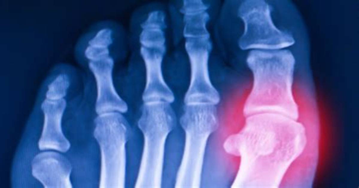 When Arthritis Becomes Debilitating?