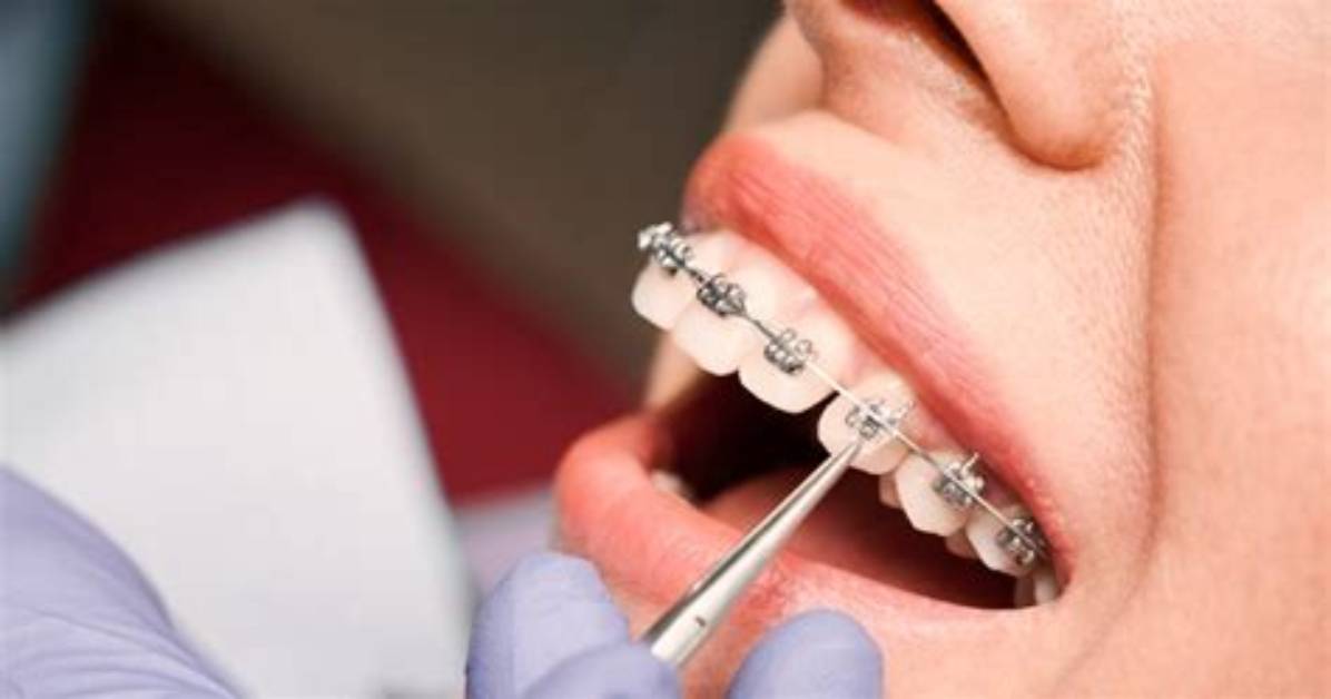 When Braces Are Tightened?