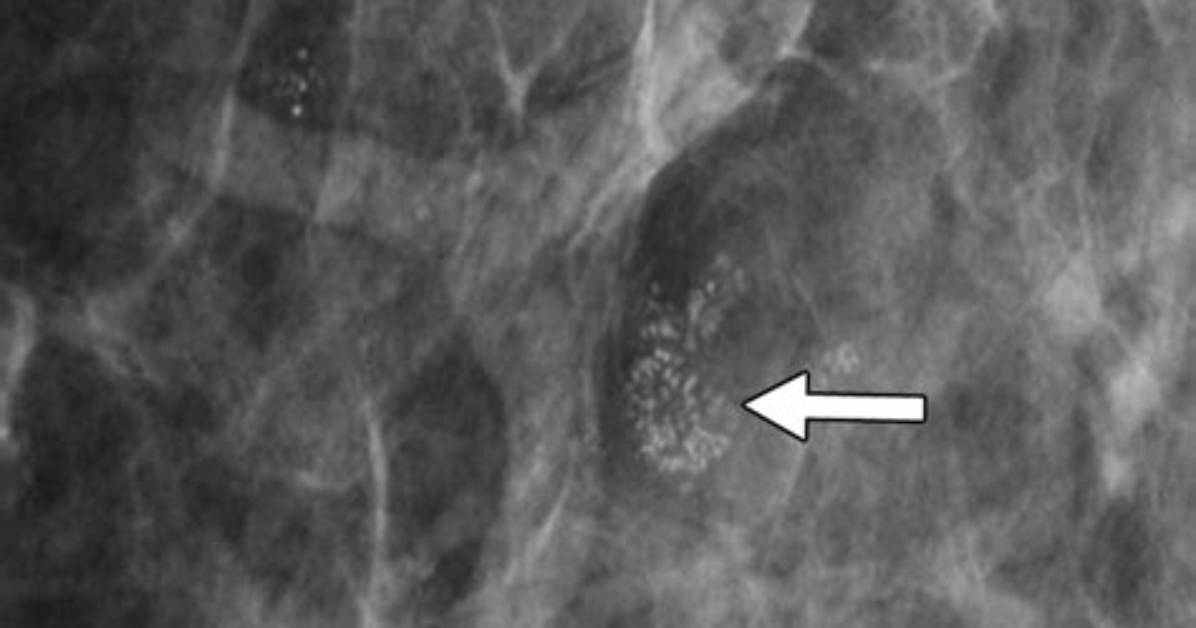 When Breast Calcifications Change?
