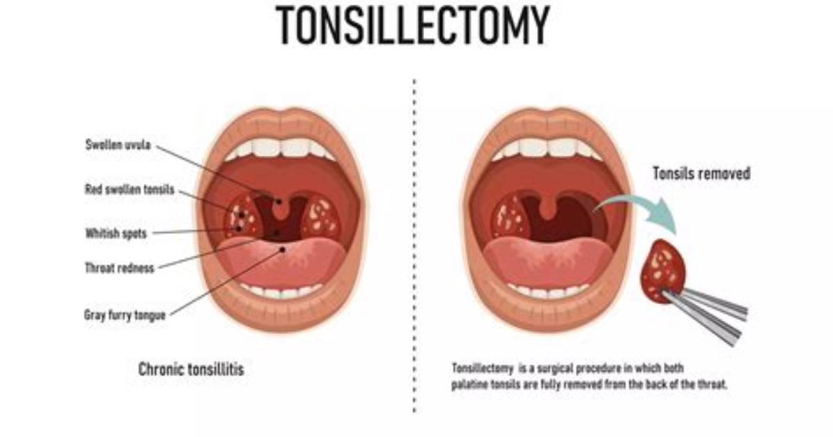 When Can You Eat After Tonsillectomy?