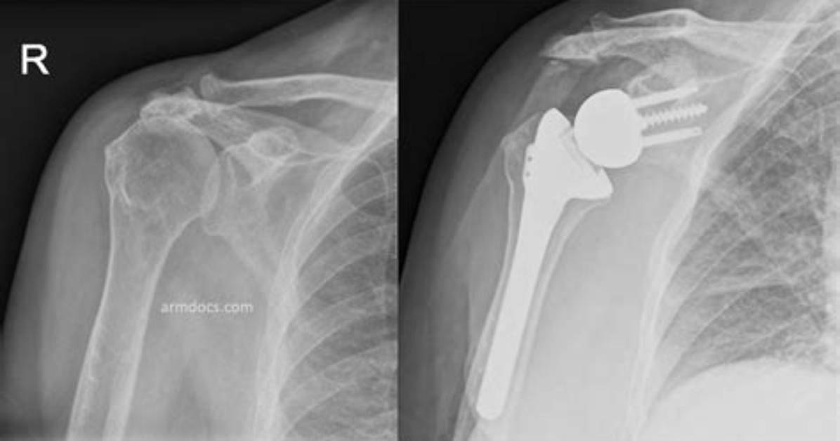 When Compared to the Shoulder the Hip Joint Has?