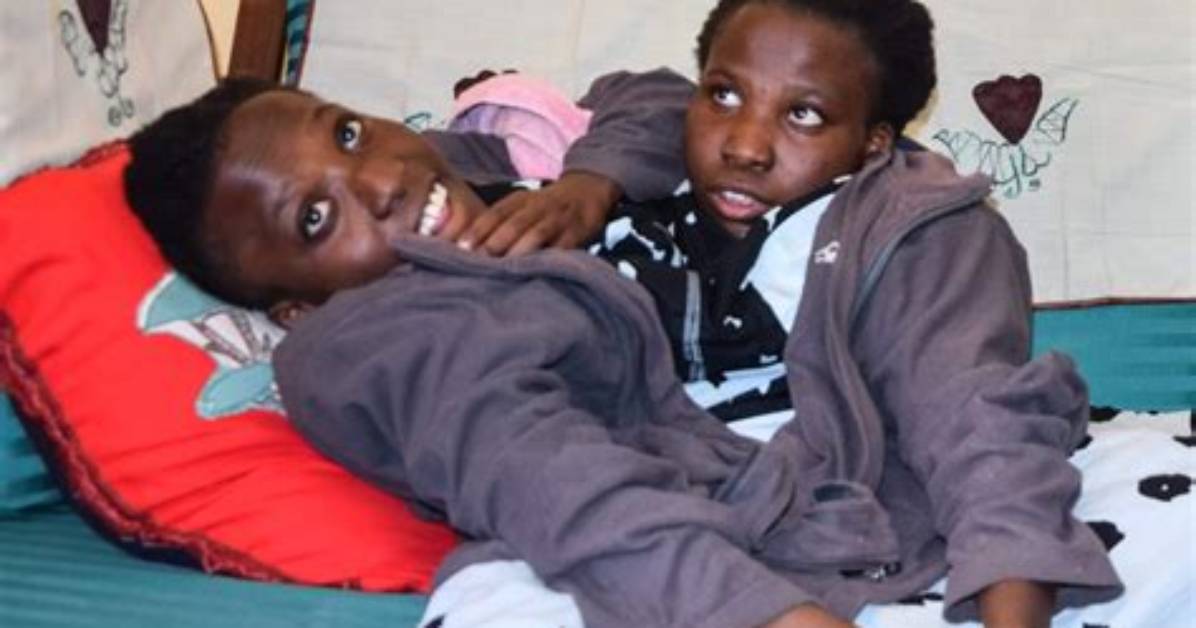 When Conjoined Twins Die?