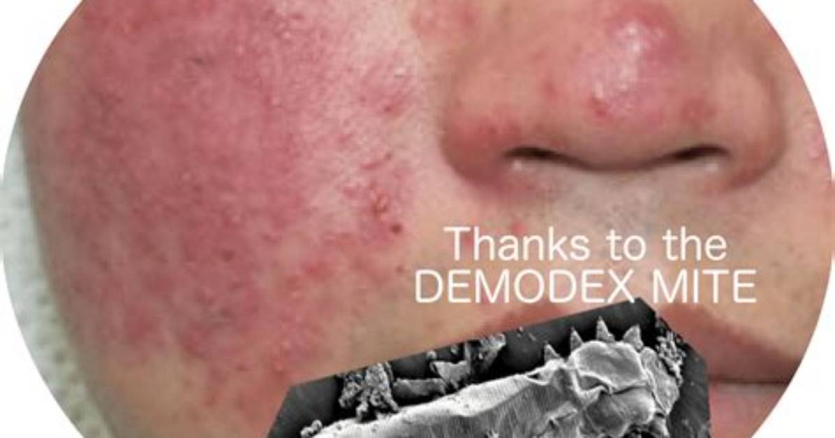 When Demodex Mites Die?