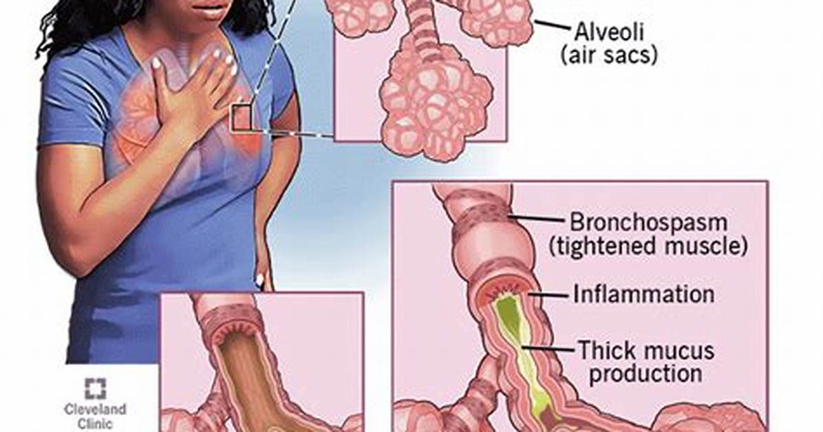 When Did Asthma Get Discovered?