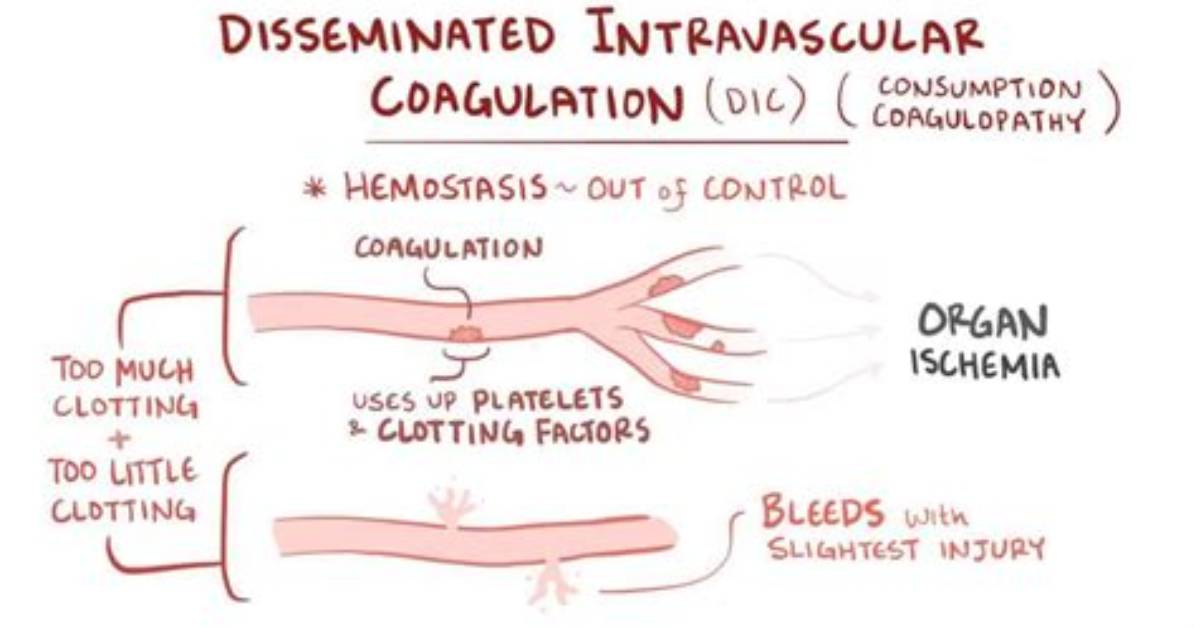 When Disseminated Intravascular Coagulation Develops?