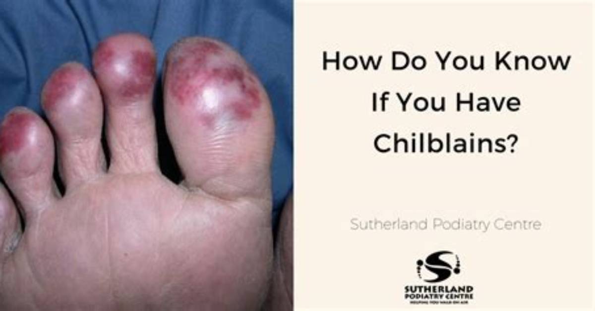 When Do Chilblains Go Away?