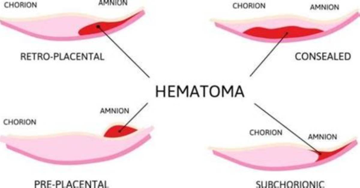 When Do Subchorionic Hematomas Form?