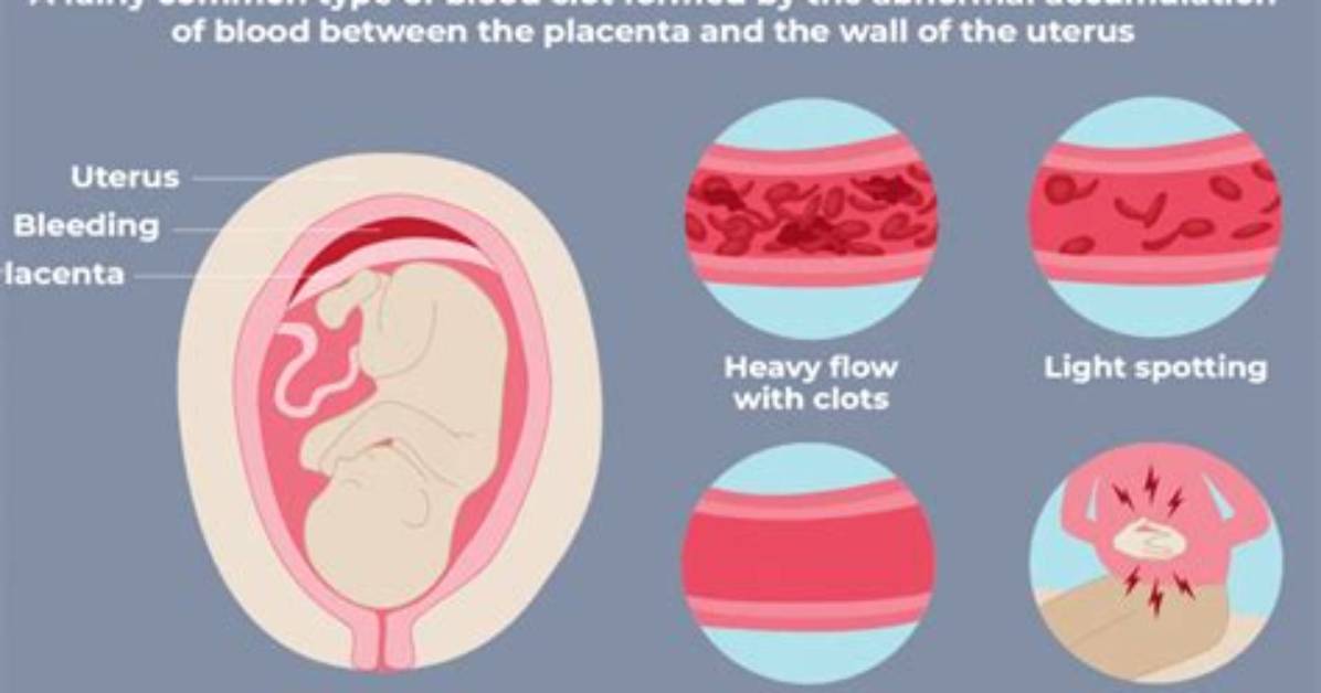 When Do Subchorionic Hemorrhages Occur?