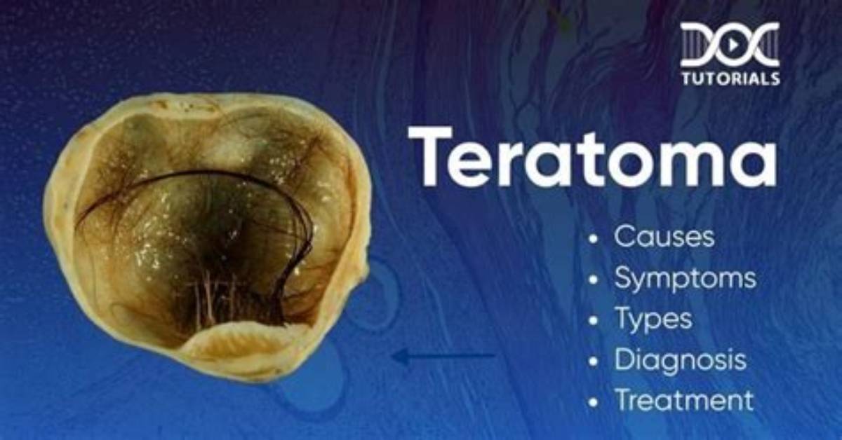 When Do Teratomas Form?