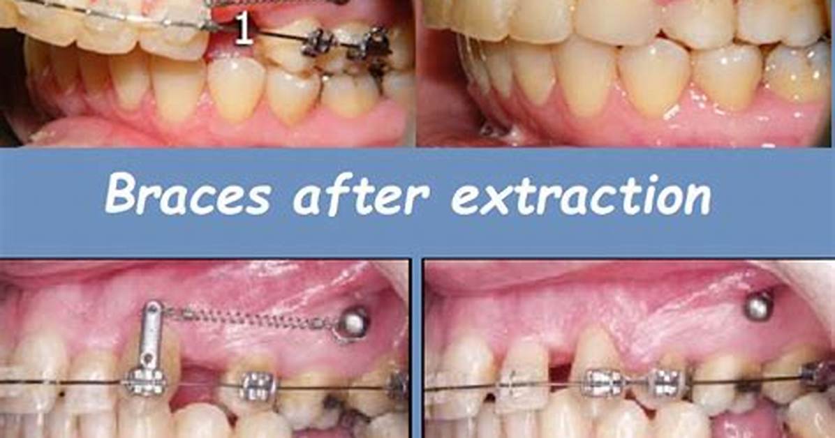 When Do You Do Serial Extraction?