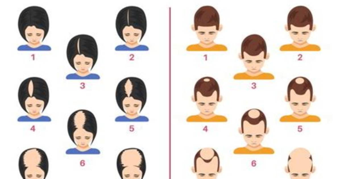 When Do You Get Alopecia?