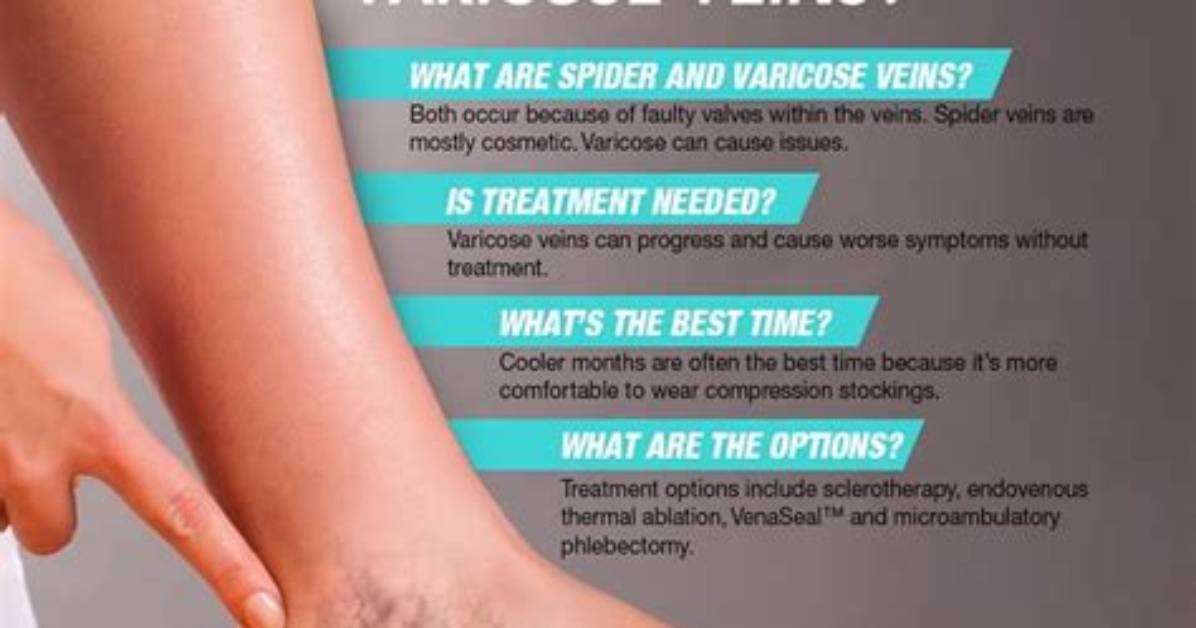 When Do You Get Spider Veins?