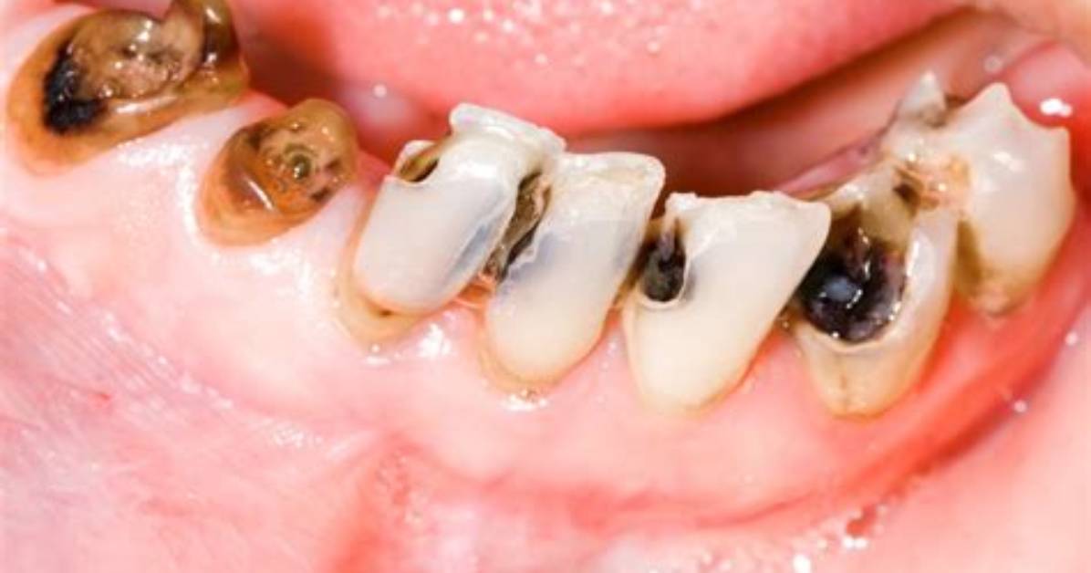 When Does a Decayed Tooth Have to Be Removed?