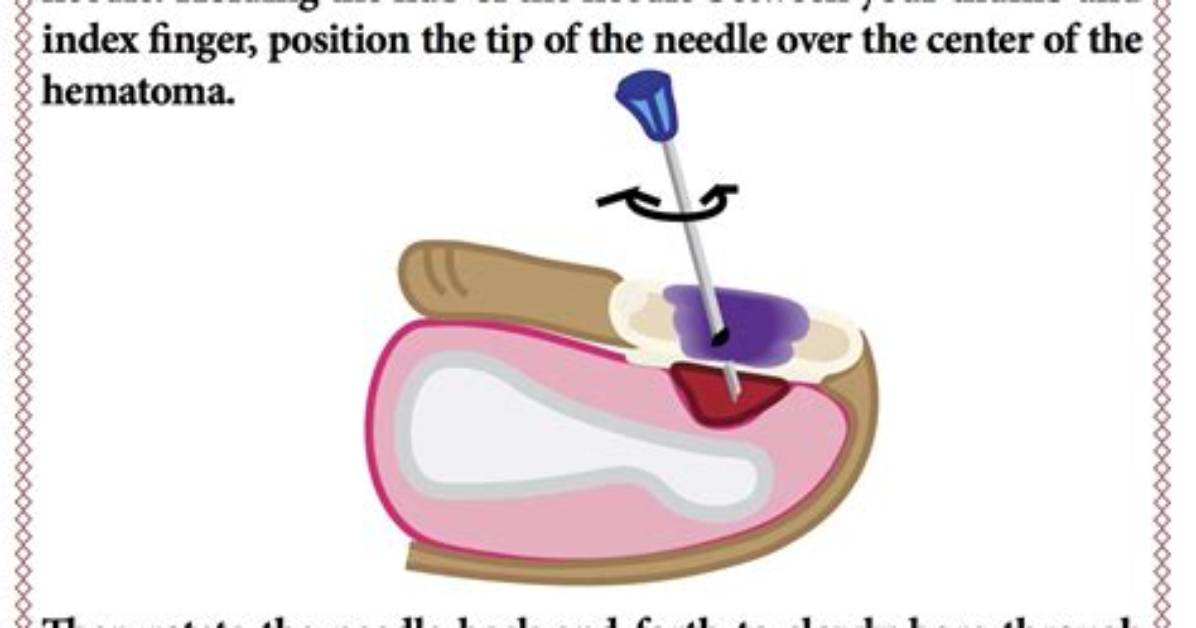 When Does a Haematoma Need Drainage?