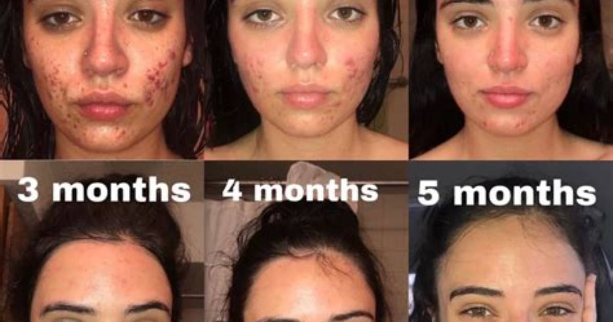 When Does Accutane Start Working
