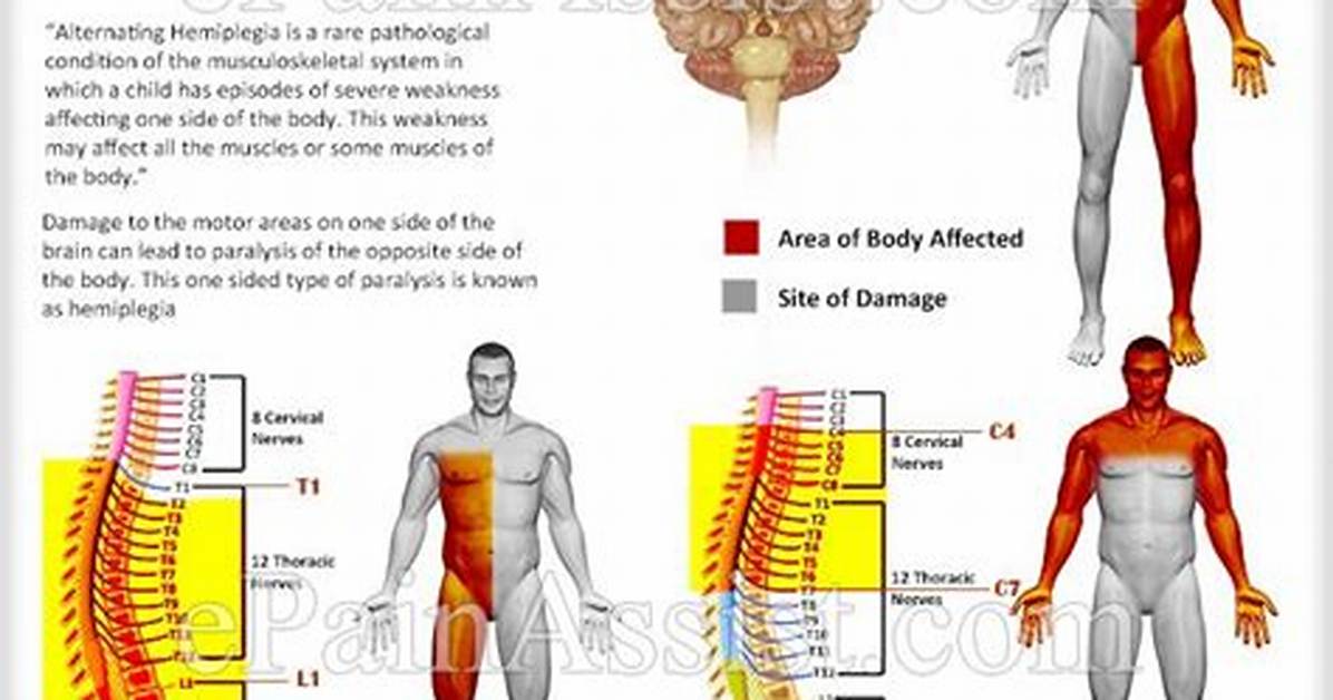 When Does Alternating Hemiplegia Occur?