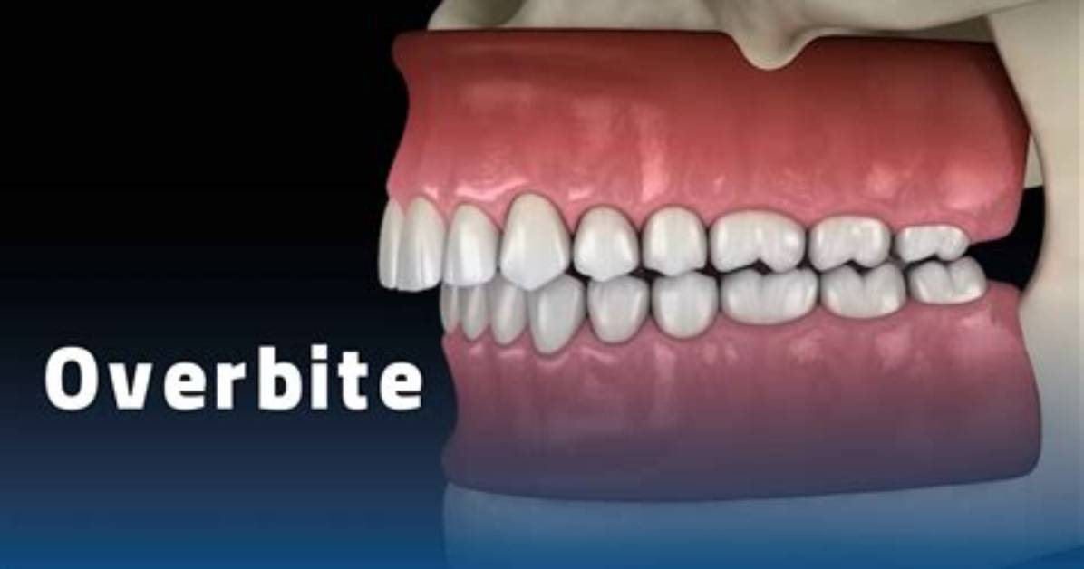 When Does an Overbite Need to Be Corrected?