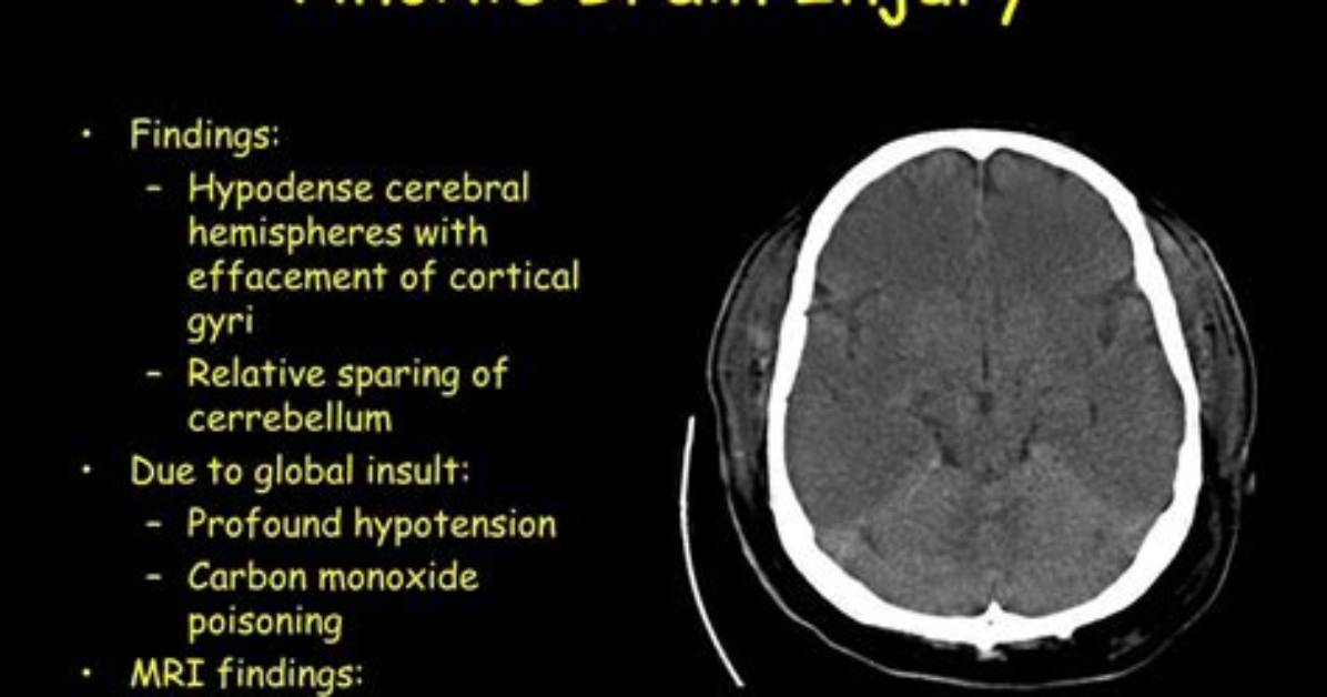 When Does Anoxic Brain Injury Occur?