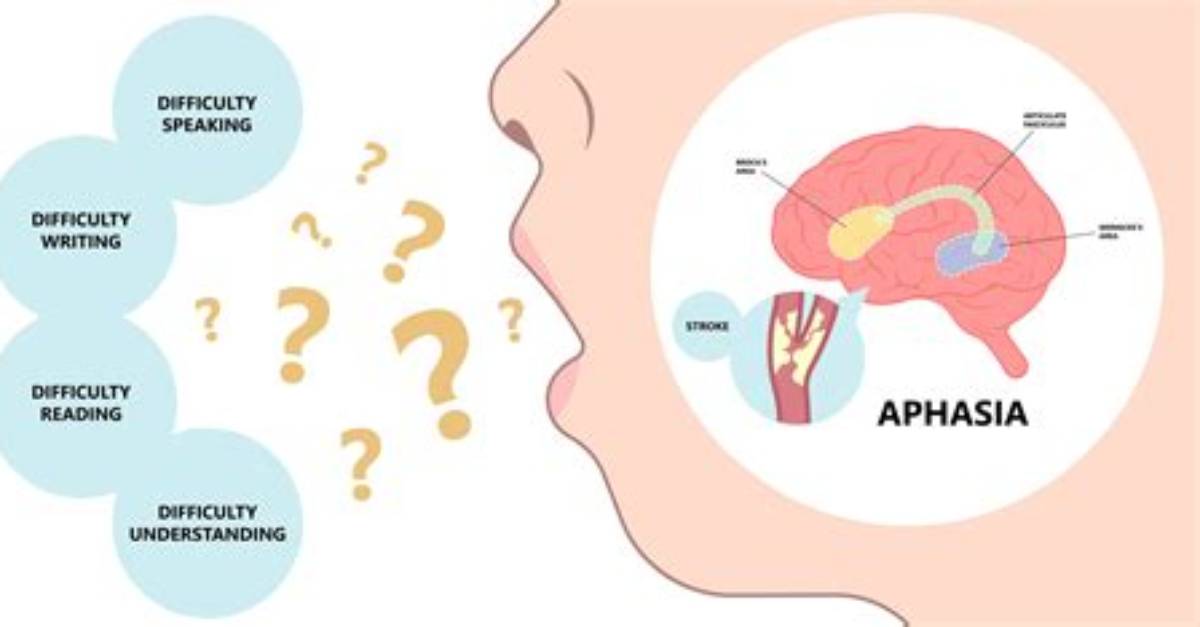 When Does Aphasia Start?