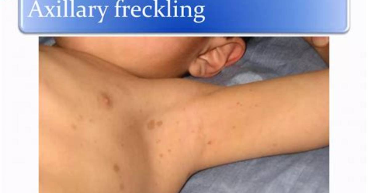 When Does Axillary Freckling Appear?