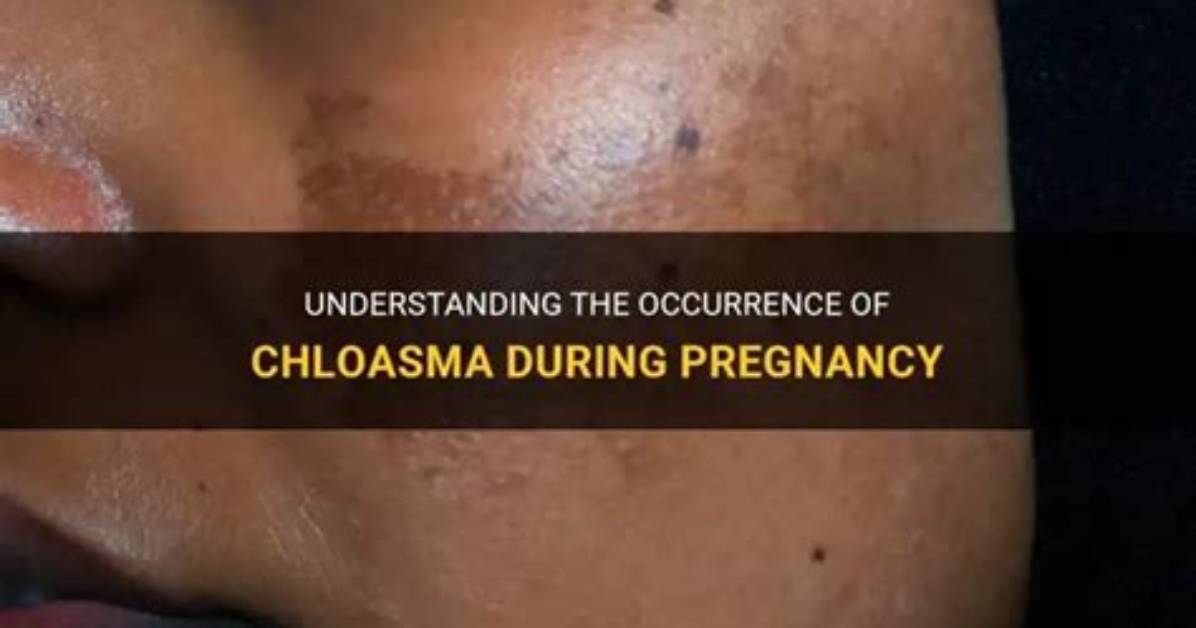 When Does Chloasma Start in Pregnancy?