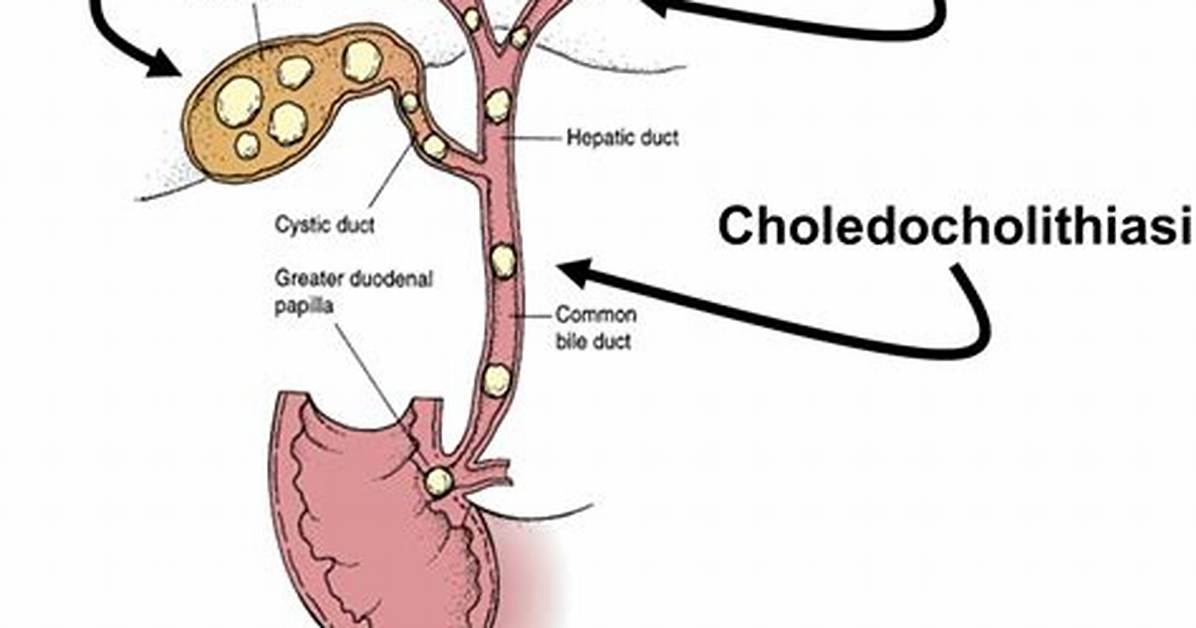 When Does Choledocholithiasis Occur?
